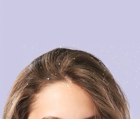 Здоровая кожа головы: что делать, если появилась перхоть