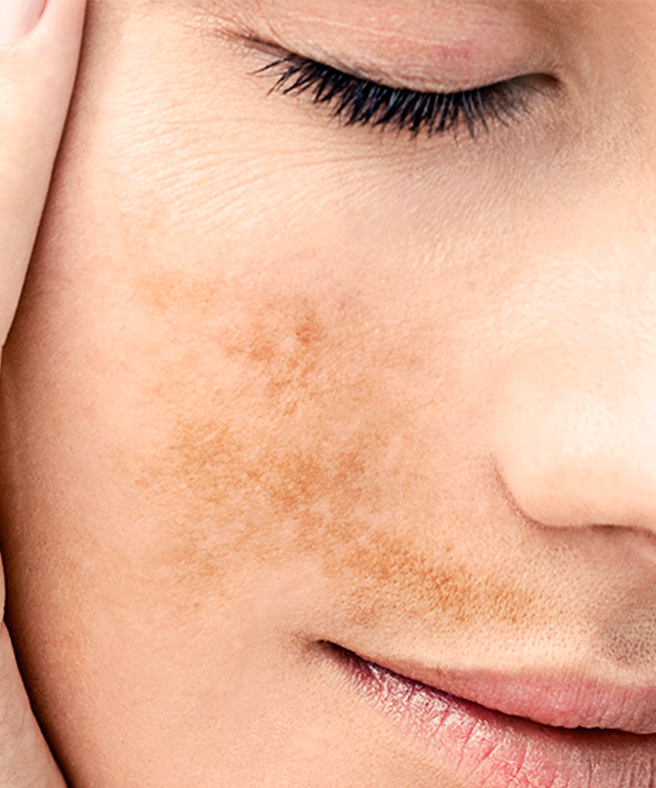 Как отбелить кожу: избавляемся от пигментных пятен и улучшаем цвет лица в домашних условиях