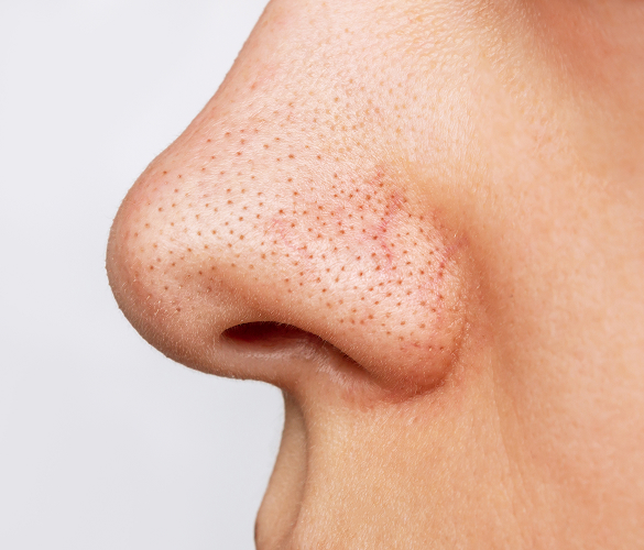 Как избавиться от черных точек: руководство для чистой и гладкой кожи 